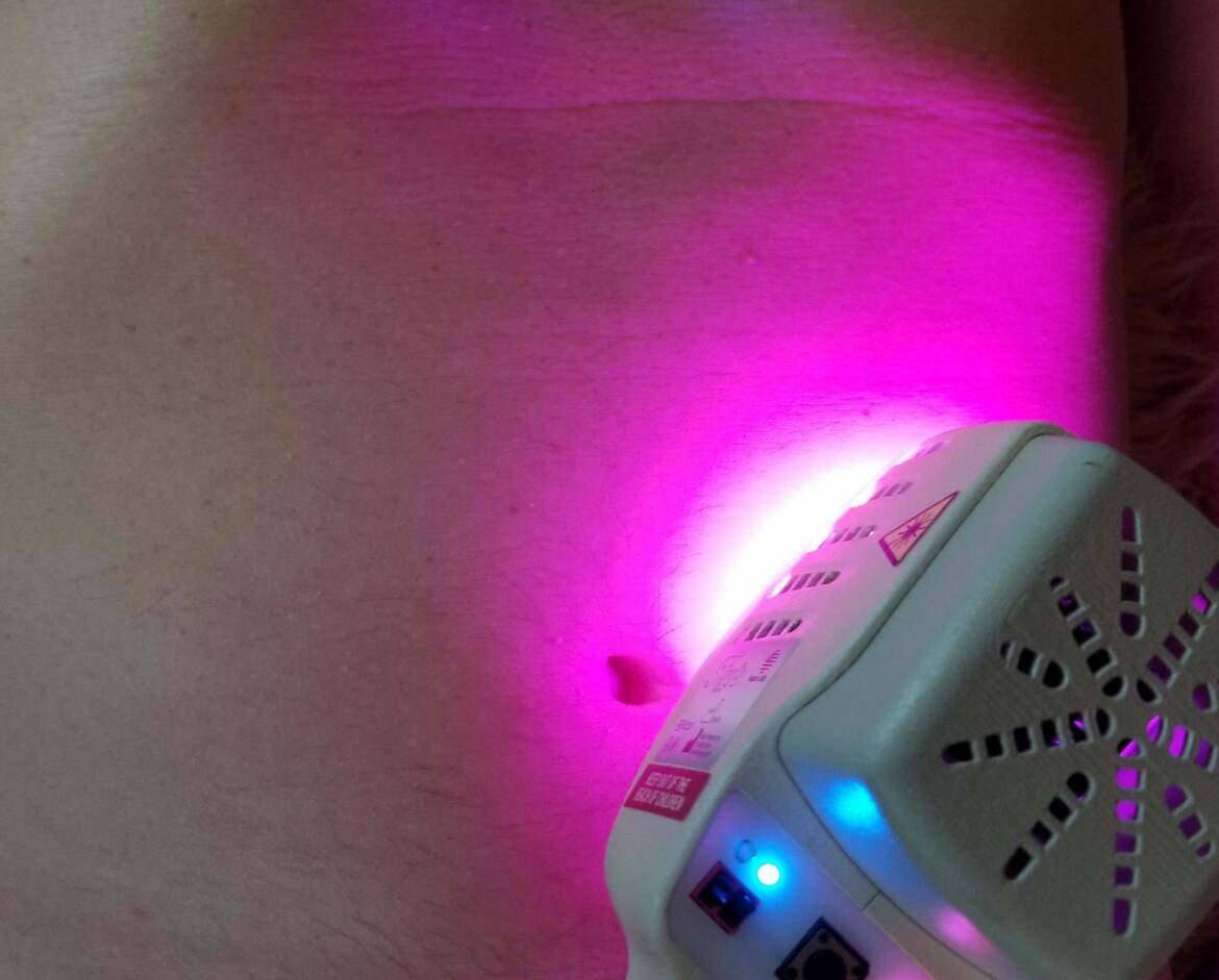FireFly Light Therapy
